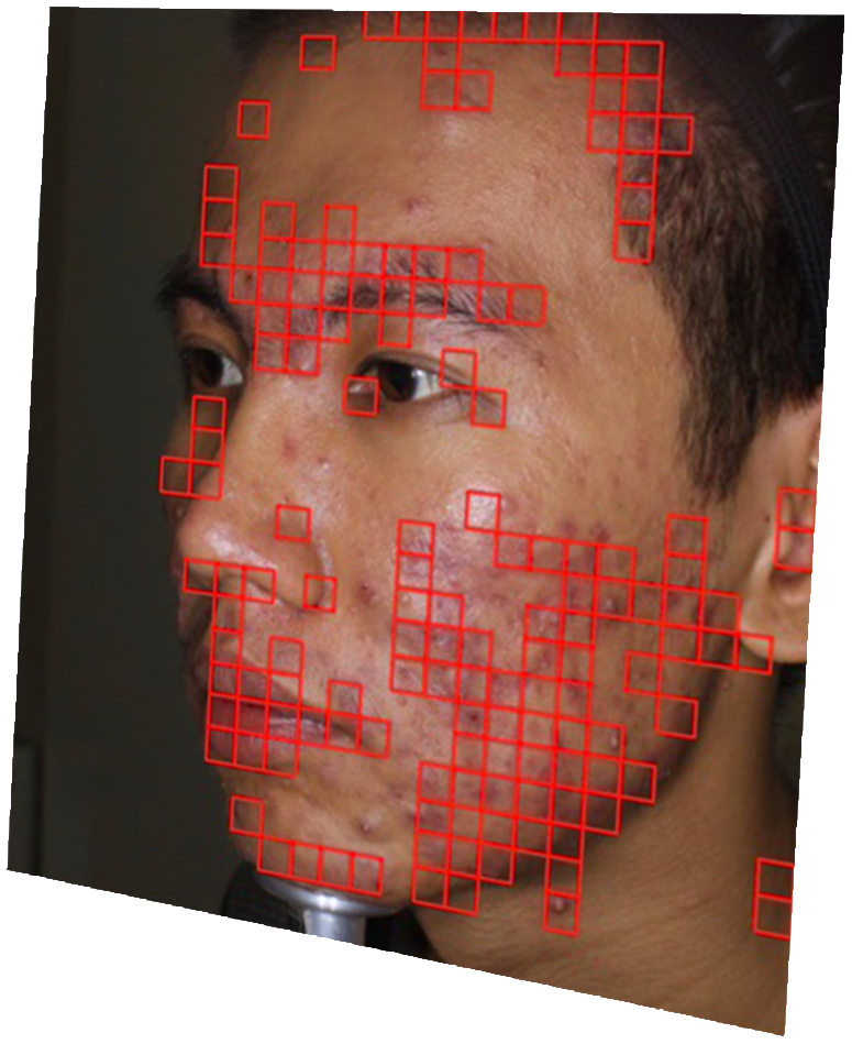 Acne Detection & Severity Classification App